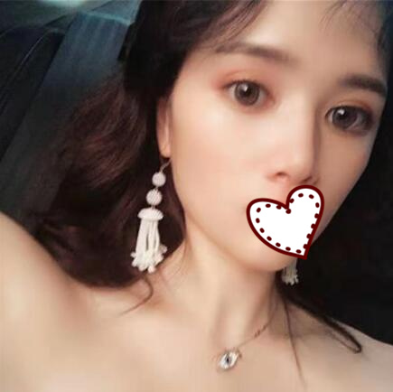 玻尿酸隆鼻果圖分享