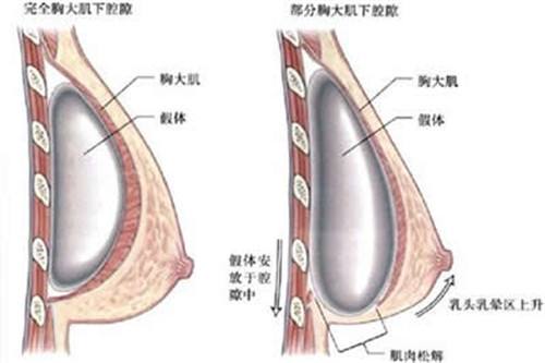 北京協(xié)和醫(yī)院科普隆胸手術(shù)