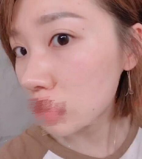 昆山百達(dá)麗醫(yī)院做眶隔離釋放法祛眼袋