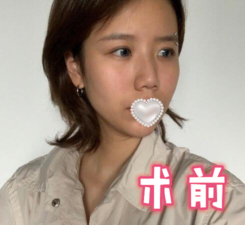 鼻尖整形手術(shù)分享
