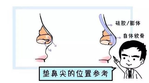 鼻尖整形手術(shù)科普
