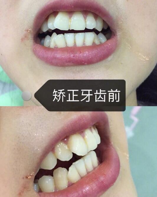 維樂(lè)口腔醫(yī)院牙齒矯正案例分享
