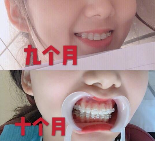 維樂(lè)口腔醫(yī)院牙齒矯正案例分享