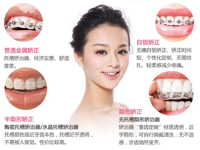 維樂(lè)口腔醫(yī)院科普牙齒矯正的錯(cuò)誤觀念