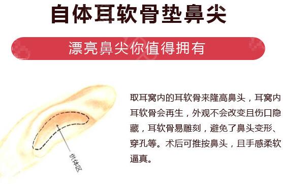 低鼻尖整形美容常見問題