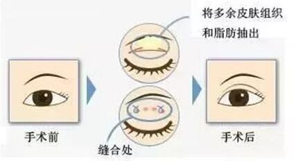 腫脹眼睛吸脂術后的護理方法