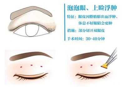 腫脹眼睛吸脂術后的護理方法