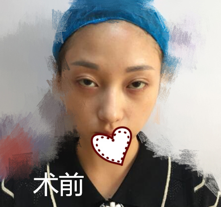 成都華西醫(yī)院美容整形科隆鼻案例