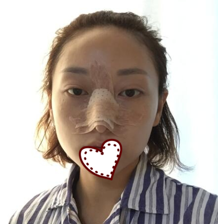 成都華西醫(yī)院美容整形科隆鼻案例