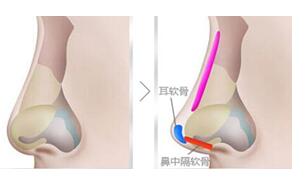 成都華西醫(yī)院美容科科普隆鼻整形手術(shù)