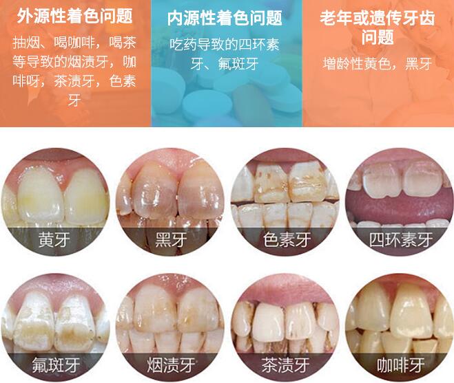 冷光美白牙齒的價(jià)格多少錢