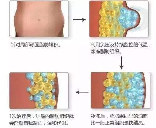 萍鄉(xiāng)麗芙整形醫(yī)院科普吸脂減肥