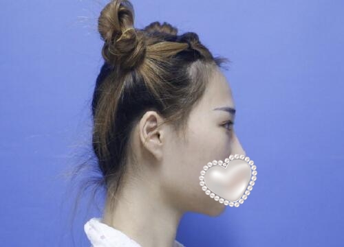 下頜角整形手術(shù)果圖對(duì)比