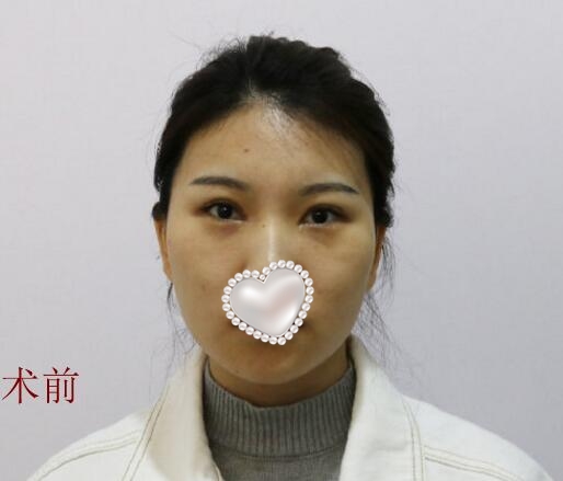 注射除皺調(diào)節(jié)果圖分享