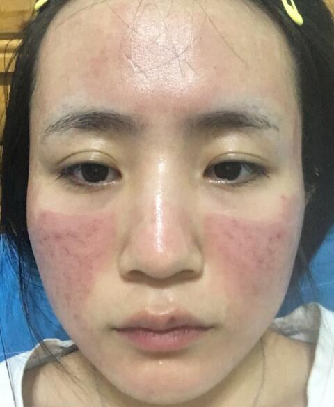 激光去除痘疤果圖分享?
