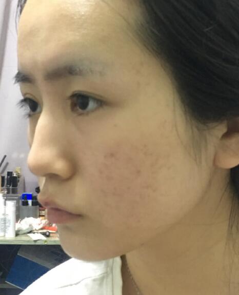 激光去除痘疤果圖分享?
