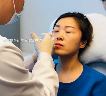 透明質(zhì)酸注射填充果圖