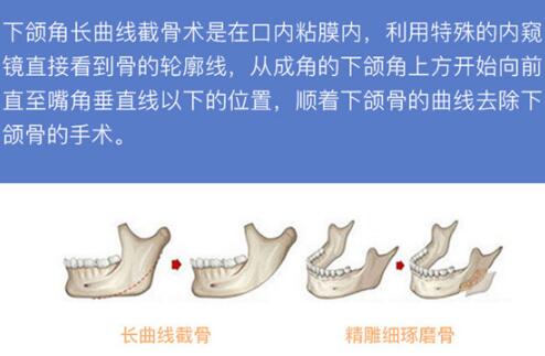 上海九院下頜角磨骨手術(shù)科普