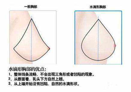 北京八大處整容醫(yī)院科普隆胸?手術(shù)