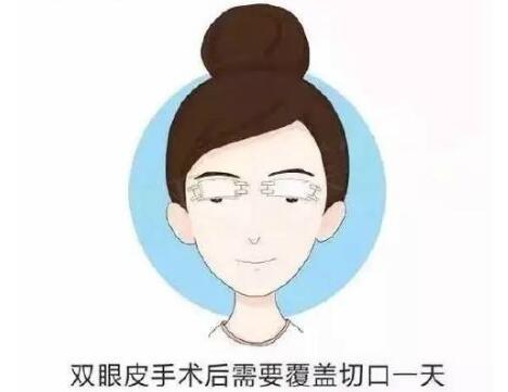 上海九院雙眼皮手術(shù)科普