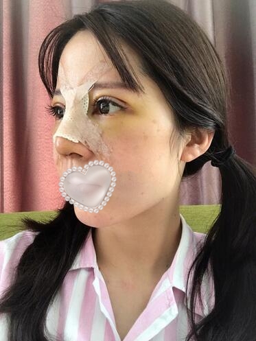 韓式自體軟骨隆鼻果圖