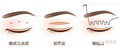 八大處甘承醫(yī)生科普雙眼皮手術(shù)知識