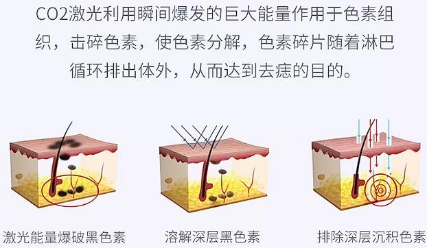 弋磯山醫(yī)院美容整形科科普激光祛痣