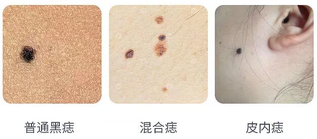 弋磯山醫(yī)院美容整形科科普激光祛痣
