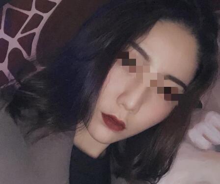自體脂肪隆下巴果圖分享