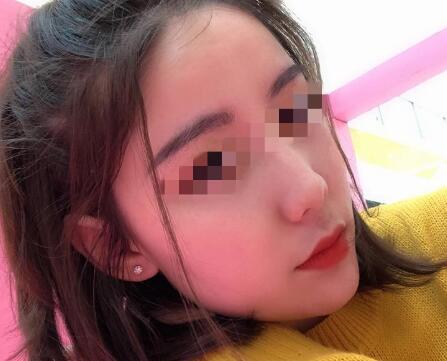 自體脂肪隆下巴果圖分享