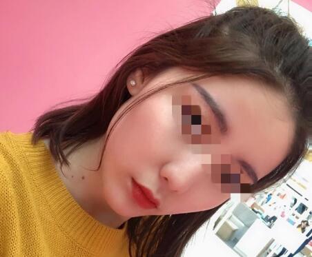 自體脂肪隆下巴果圖分享
