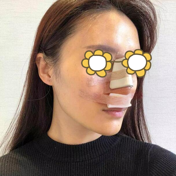 合肥壹加壹整形美容醫(yī)院隆鼻案例分享