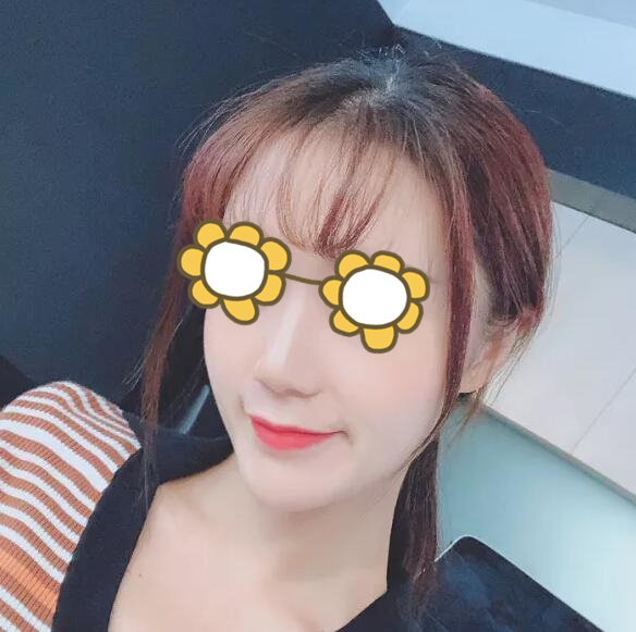 合肥壹加壹整形美容醫(yī)院隆鼻案例分享