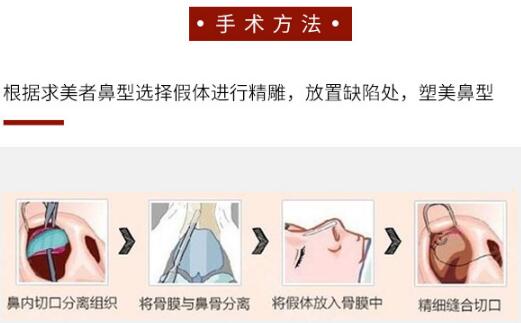 做隆鼻手術好嗎