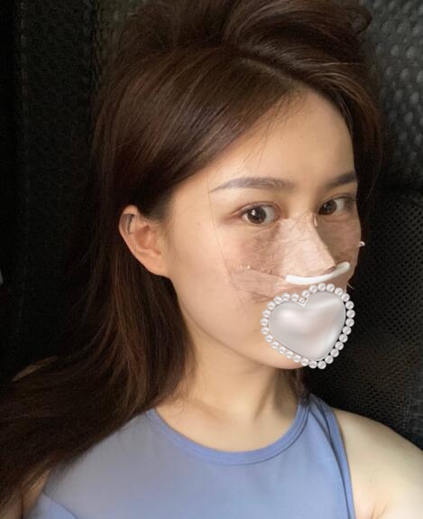 做隆鼻手術體驗日記