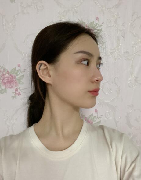 做隆鼻手術體驗日記