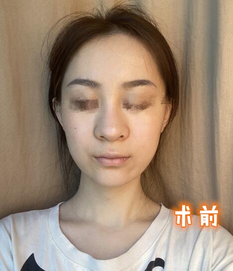 做隆鼻手術體驗日記