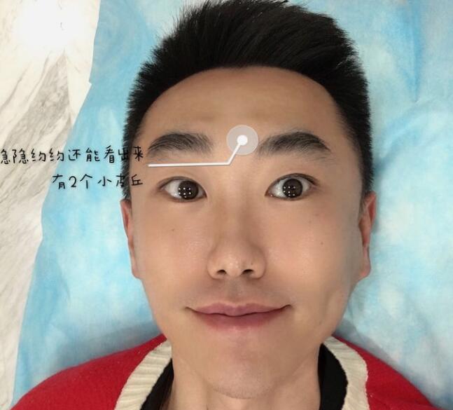 眉間注射除皺術(shù)后對(duì)比圖