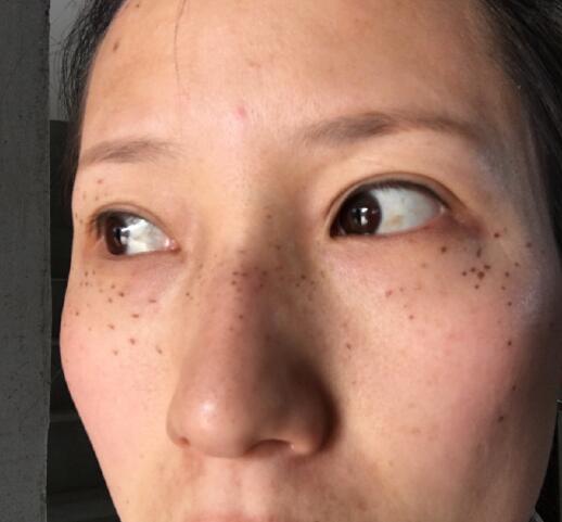 廈門歐菲整形醫(yī)院超激光美膚祛斑案例分享