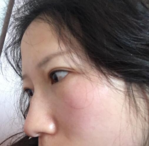 廈門歐菲整形醫(yī)院超激光美膚祛斑案例分享