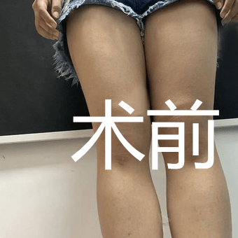 韓國(guó)延世整形醫(yī)院大腿吸脂案例