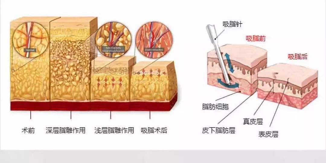 韓國(guó)延世整形醫(yī)院科普大腿吸脂手術(shù)