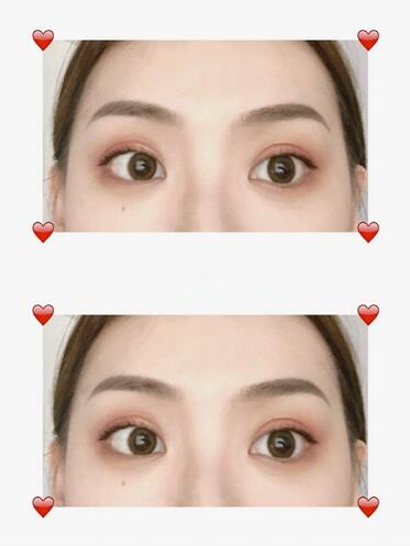 四、眉部整形紋眉手術(shù)果圖?