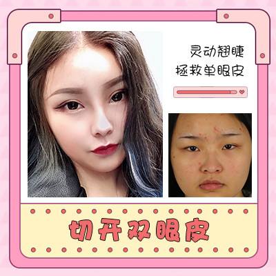 臺(tái)州中心醫(yī)院整形科普雙眼皮?手術(shù)