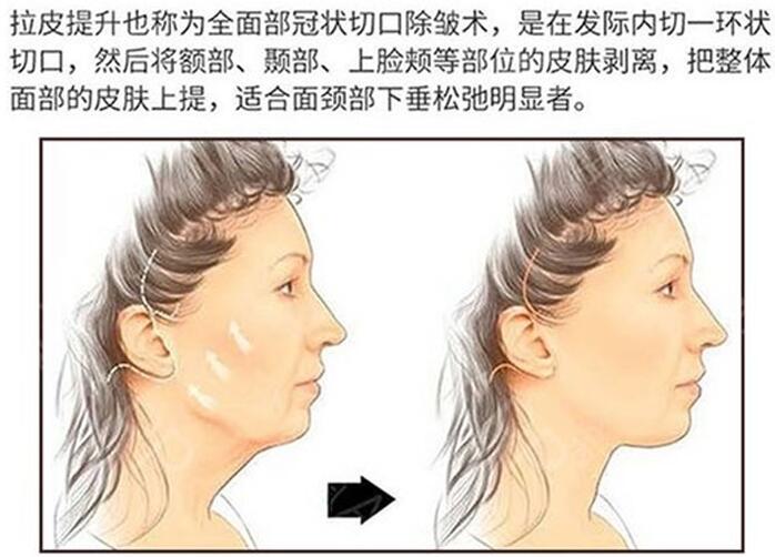 崔東俊醫(yī)生科普面部緊致提升除皺