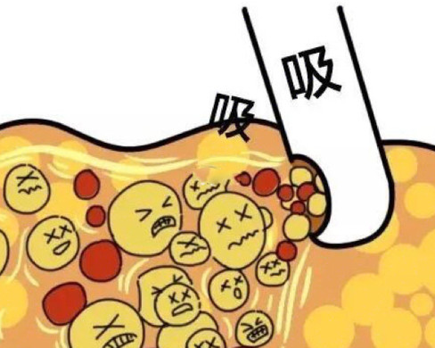 深圳鵬程整形醫(yī)院科普吸脂手術