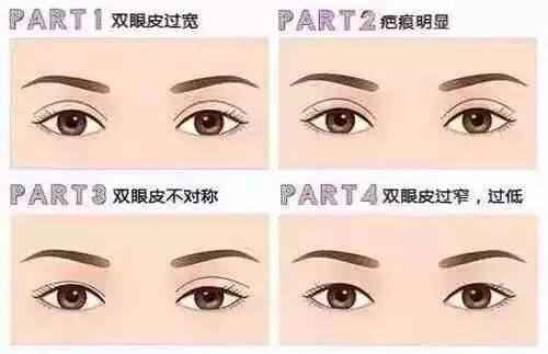曹仁昌醫(yī)生科普修復(fù)雙眼皮手術(shù)