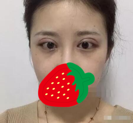 金華人民醫(yī)院美容醫(yī)院雙眼皮案例