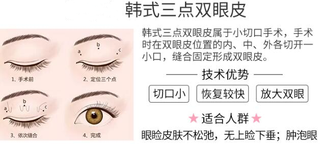 金華人民醫(yī)院美容醫(yī)院科普雙眼皮手術