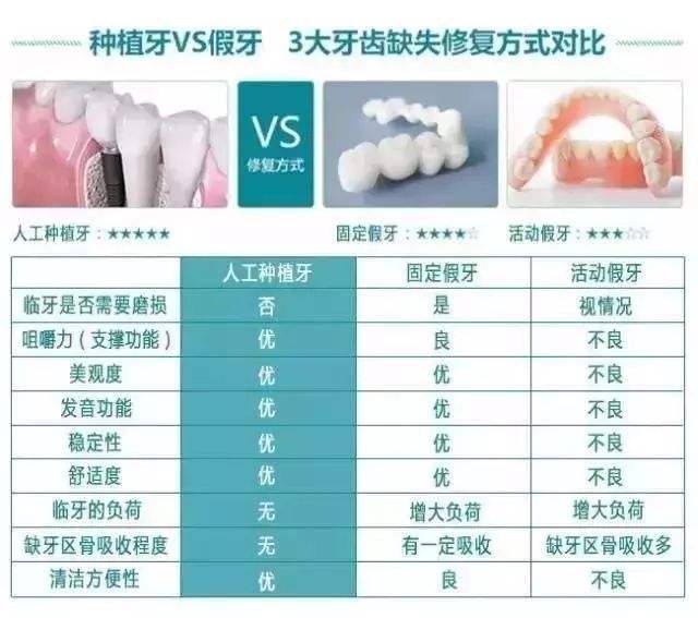 上海九院科普種植牙的優(yōu)點(diǎn)